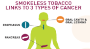 Smokeless Tobacco Links to 3 Types of Cancer graphic