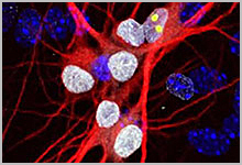 Neurons from an ALS patient.
