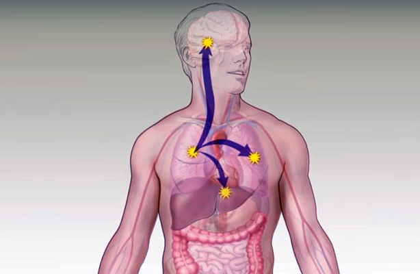 An illustration of a male body with arrows showing how cancer can spread from the lung to the brain, the other lung, and the liver.