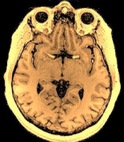 Brose Brain Scan