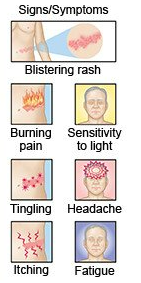 shingles symptoms