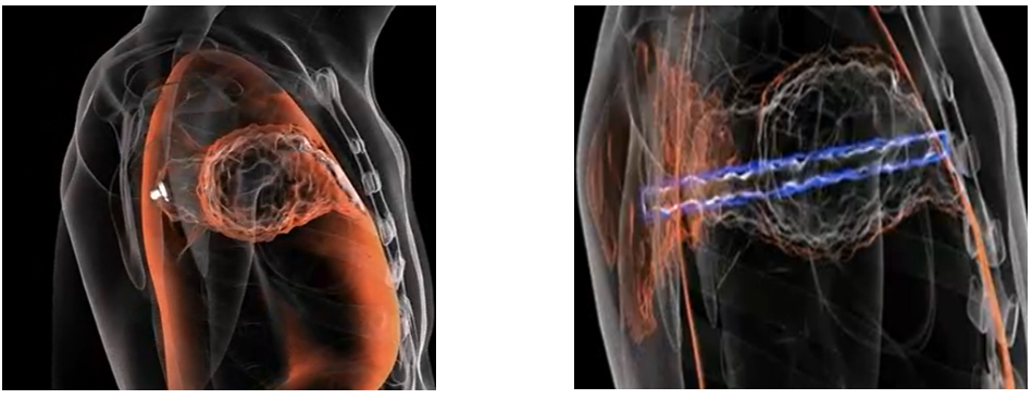 Images of a .223 bullet tearing up a lung verses the effect of a 9mm bullet