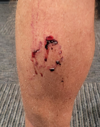 Picture of Steve's calf with a bloody dog bite