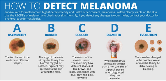 ABCs of Melanoma
