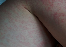 Red rash on unidentified body part