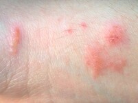 Urushiol-induced contact dermatitis from poison oak - Wikipedia image