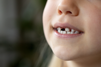 Close-up of a child's mouth showing a missing front tooth and small white teeth.
