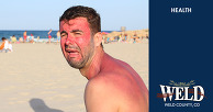 A man crying after being badly sunburned.
