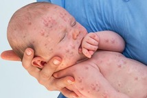 Image of a child with measles