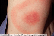 Circular, expanding rash with target-like appearance known as the "bull's-eye" rash associated with Lyme Disease