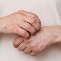 Image of hands covered in measles
