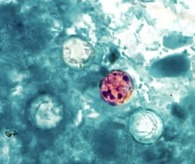 Cyclosporiasis microscopic picture