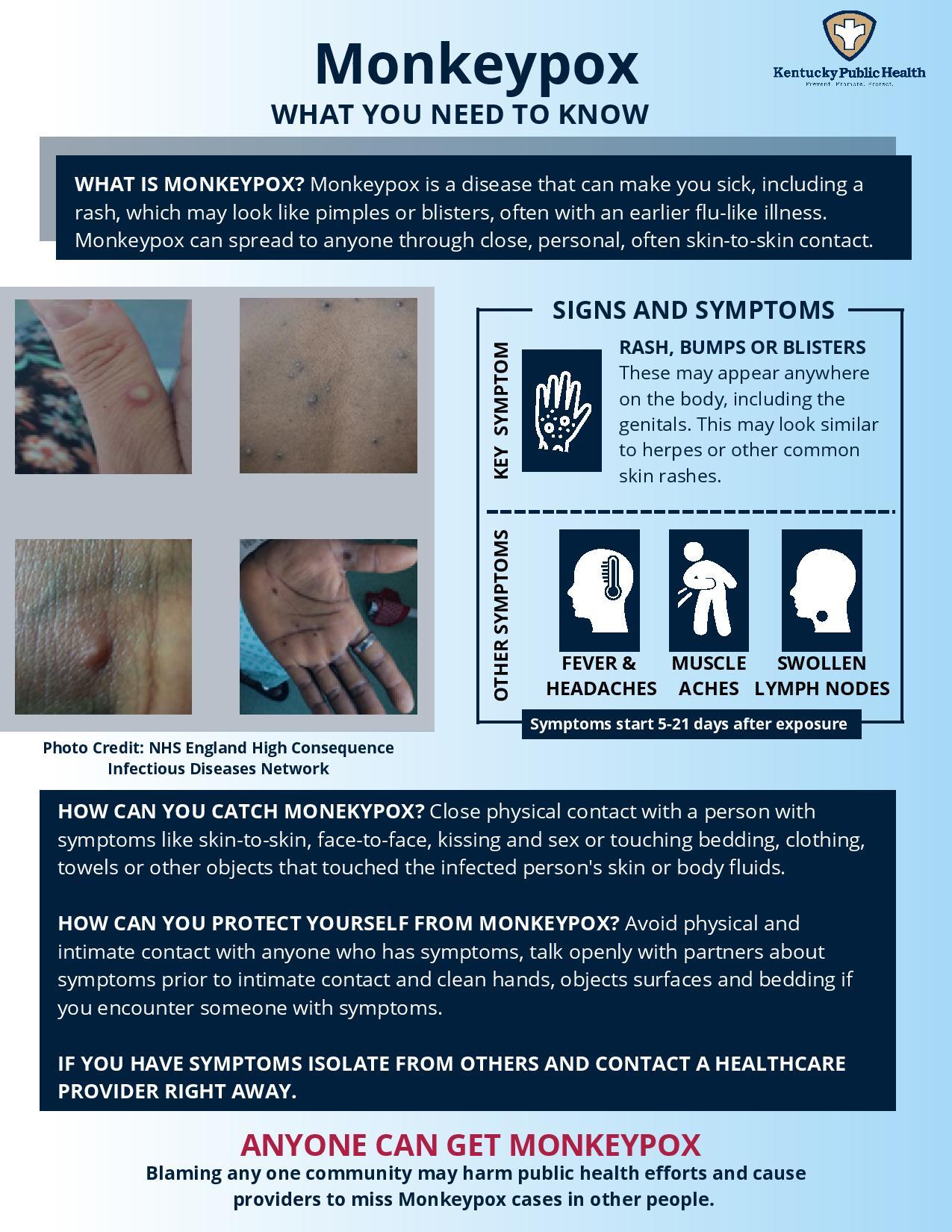 Monkeypox info July 2022