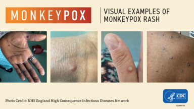 monkeypox graphic