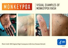 monkeypox