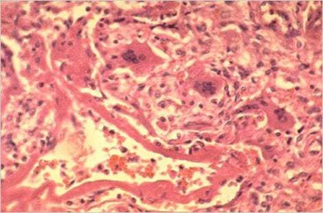 Health Officials Announce Potential Measles Exposure at Bethesda Office Building  