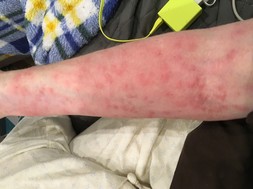 Browntail moth rash.  Anonymous photo, used by permission