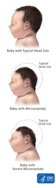 microcephaly
