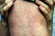 Child's back with measles rash
