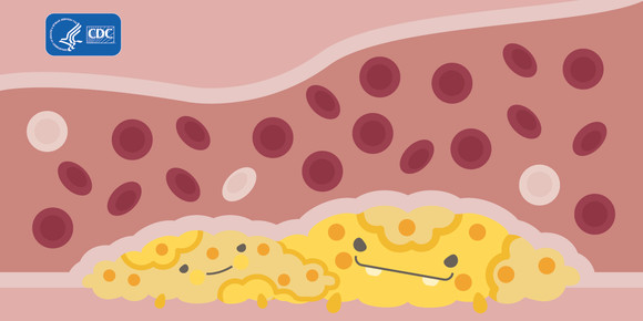 cholesterol blob