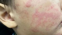 measles