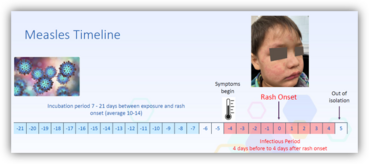 measles-disease-progression