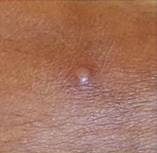 Monkey causes distinct raised swellings