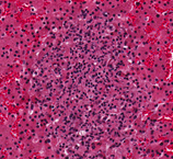 Focus of necrotizing hepatitis in an adult female gray fox (200X magnification)
