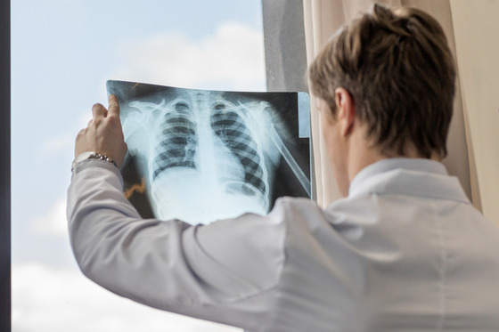 Photo of a doctor looking at a lung X-ray