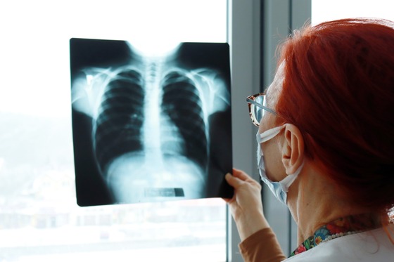 Photo of a health professional looking at a lung X-ray