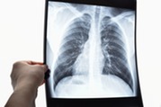 Photo of a health care worker holding up a lung X-ray