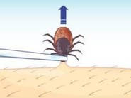 graphic of tick removal
