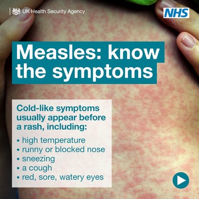 Measles