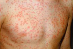 person with measles
