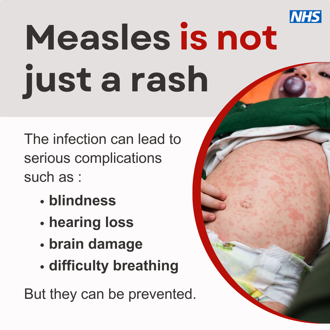 Measles vaccine 