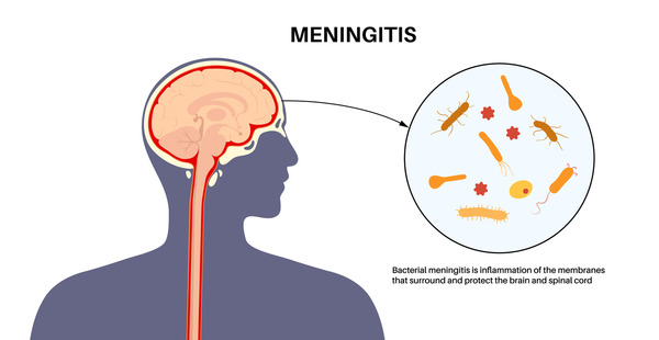 Meningitis