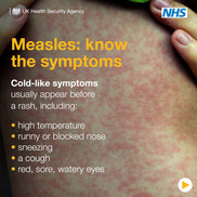 measles know the symptoms