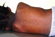 Measles rash