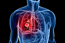 lung disease