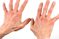 Image of two hands with skin irritation from allergic reaction