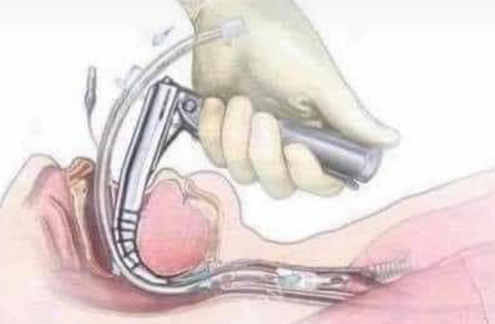 Intubation