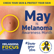 Melanoma Focus-branded graphic featuring a mole on a person's back, captioned: 'May is Melanoma Awareness Month'.