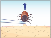 Drawing of a tick being removed by tweezers out of the skin, pulling upwards