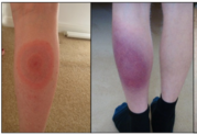 Two side by side photos of a round 'bullseye' type red rash on the leg