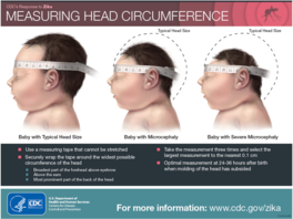 Measuring guidance for microcephaly