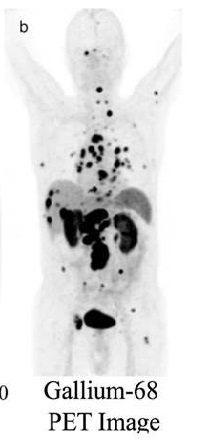 Photo of a medical image of a body, showing darker areas where cancer is. Labeled "Gallium-68 PET image"