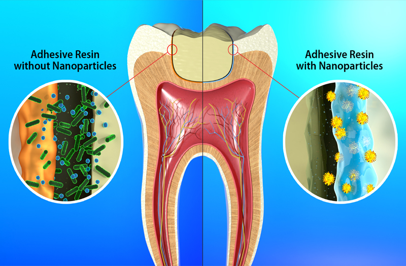 Diagram of a tooth showing how there are bacteria in the adhesive resin without nanoparticles and none in the one with nanoparticles