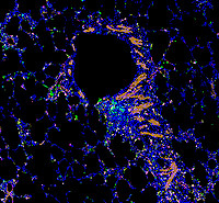 OC_OCS_OCET_SARS-CoV-2-infected lung tissue_Stanford