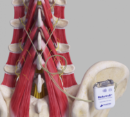 Reactiv8 Implantable Neurostimulation System