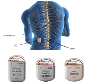 Senza Spinal Cord Stimulation System
